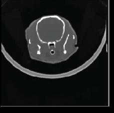 BrainInfarctCT2
